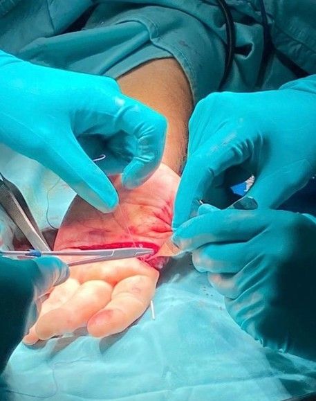 Scopri di più sull'articolo Perde quattro dita sul lavoro, reimpiantate