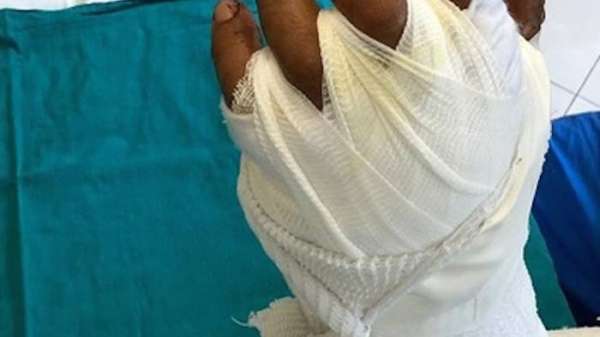 Scopri di più sull'articolo Braccio fuori auto, mano amputata: riattaccata in 11 ore